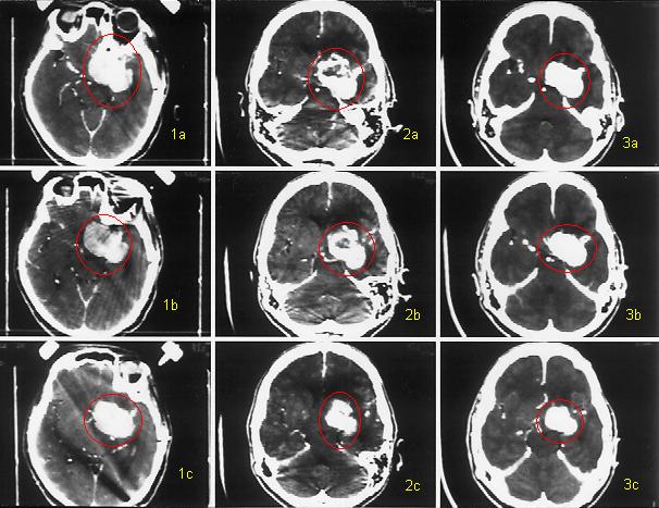{Brain Tumor Treatment Results Meningioma with Radiosurgery}